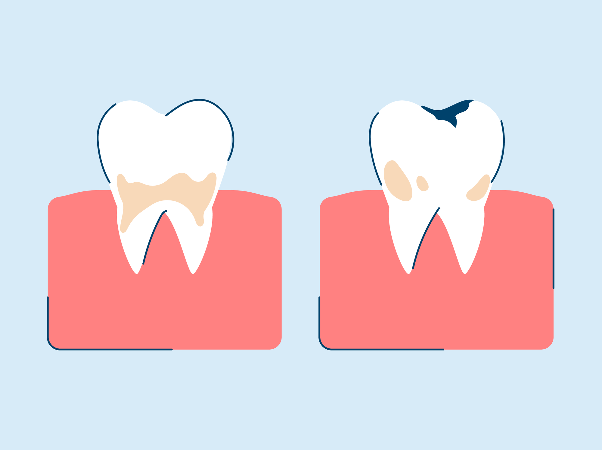 Tooth Decay: Causes, Symptoms, and Treatment