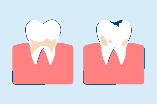 Tooth Decay: Causes, Symptoms, and Treatment