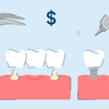 5 Types of Dental Implants: Procedure and Costs