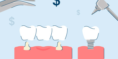 5 Types of Dental Implants: Procedure and Costs