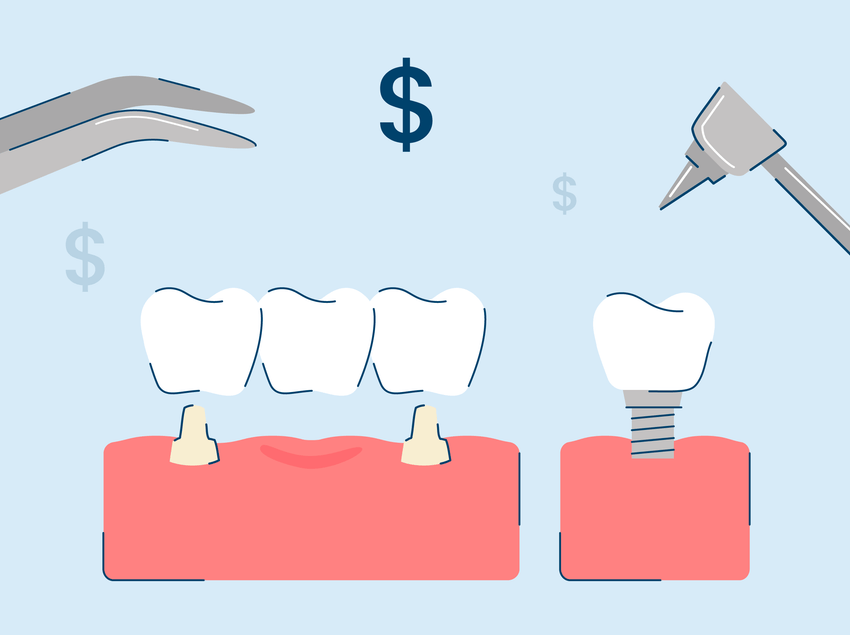 5 Types of Dental Implants: Procedure and Costs