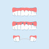 Types of Dentures and Cost: Everything You Need to Know
