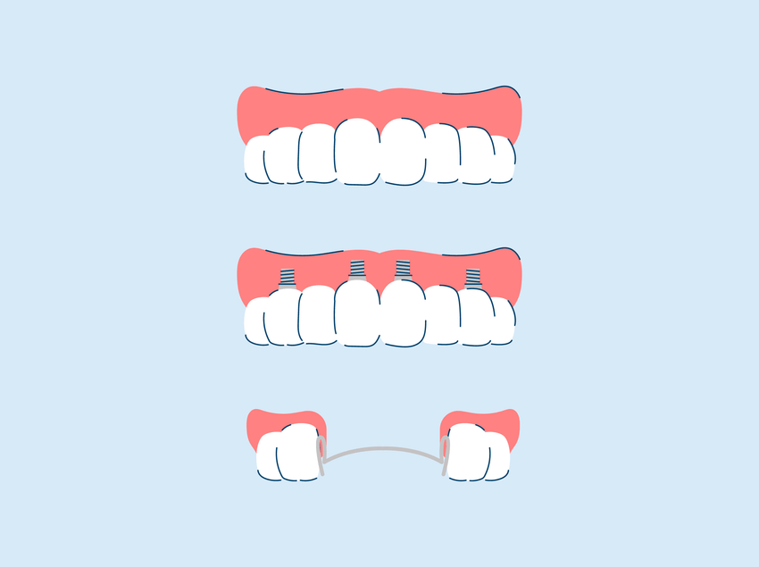 Types of Dentures and Cost: Everything You Need to Know