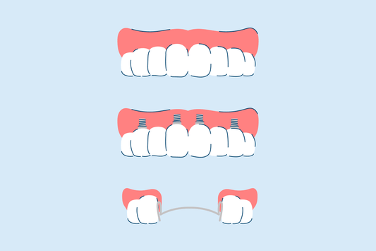 Types of Dentures and Cost: Everything You Need to Know