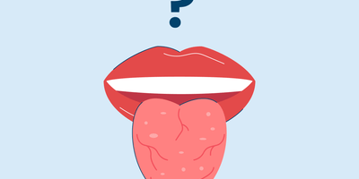 What Is a Fissured Tongue?