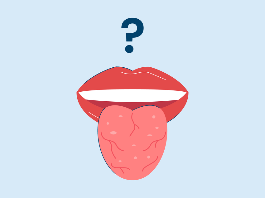 What Is a Fissured Tongue?