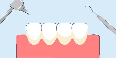 What Causes Tartar on Teeth?