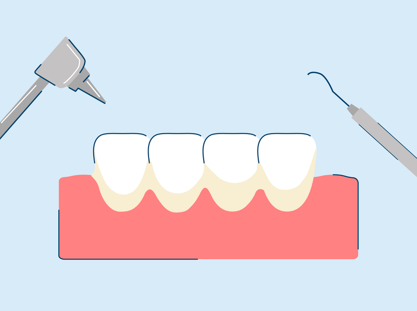 What Causes Tartar on Teeth?