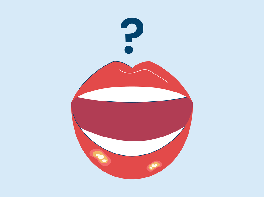 What is The White Stuff in a Canker Sore? Picture of an illustration of a mouth with canker sores.