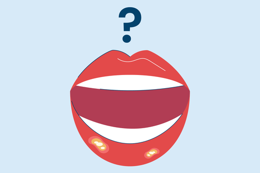 What is The White Stuff in a Canker Sore? Picture of an illustration of a mouth with canker sores.