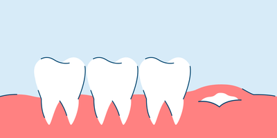 Wisdom Teeth Symptoms (When They're Growing In)