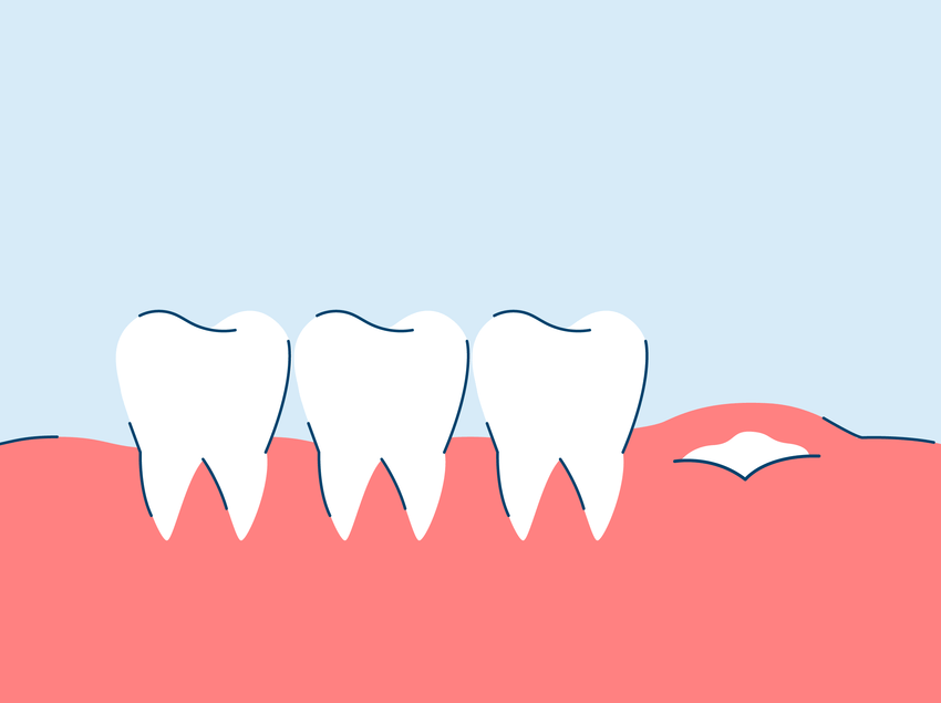 Wisdom Teeth Symptoms (When They're Growing In)