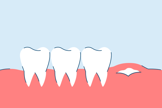 Wisdom Teeth Symptoms (When They're Growing In)