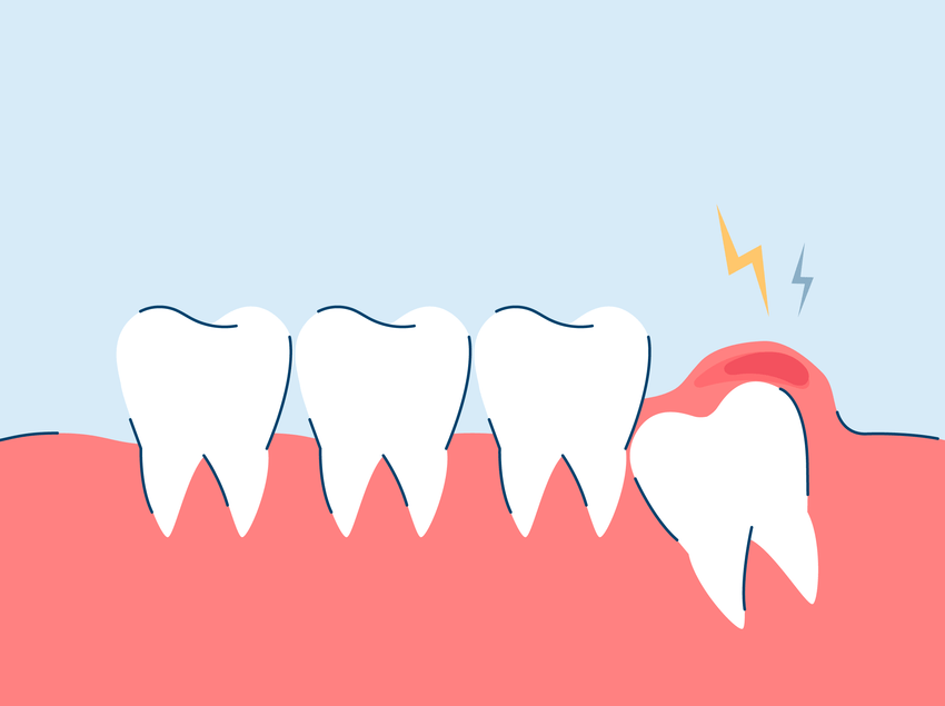 Wisdom Tooth Infection: Prevention, Symptoms, and Treatments