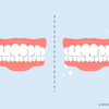 before and after water flosser