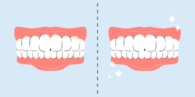 before and after water flosser