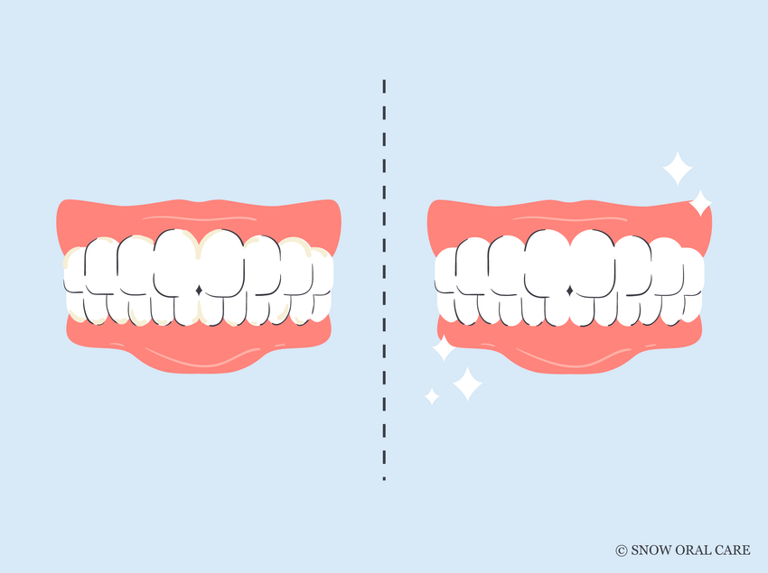 before and after water flosser