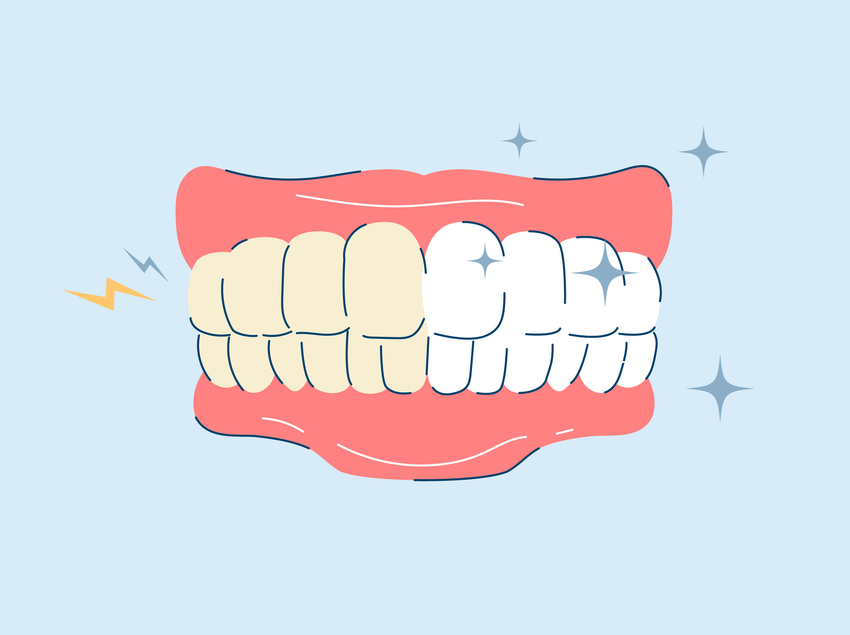 best teeth whitening for sensitive teeth