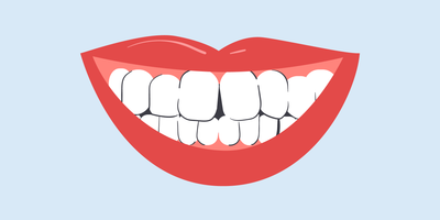 best teeth whitening for crooked teeth 