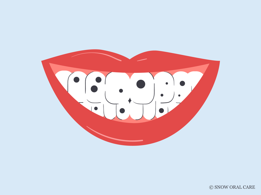 black stains on teeth 