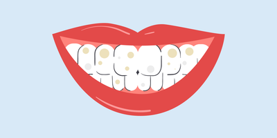 brown and white spots on teeth 