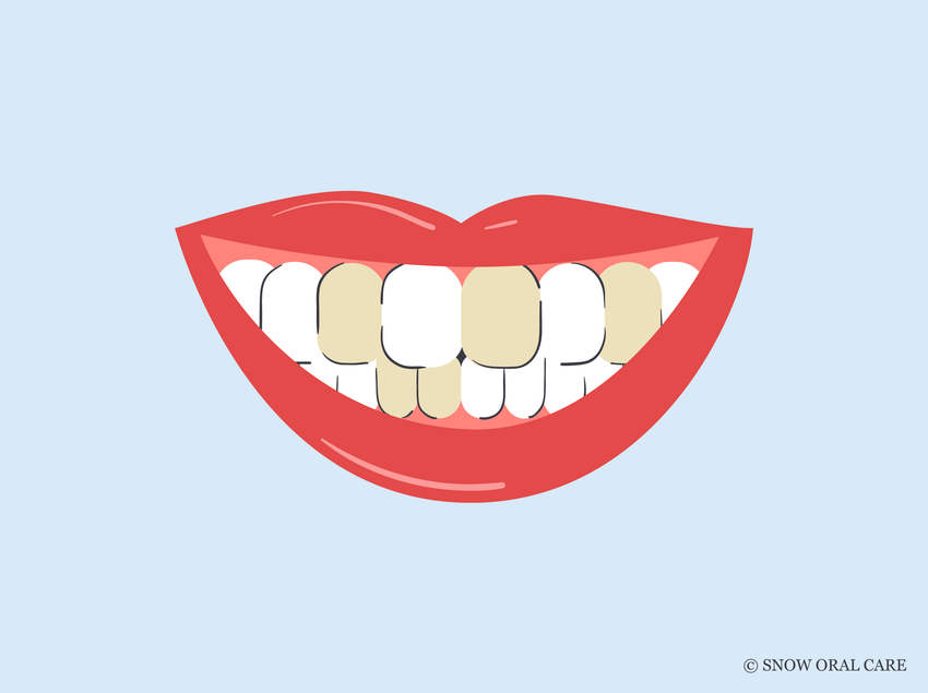 brown teeth causes 