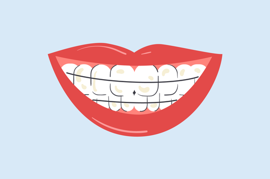 can a retainer stain your teeth