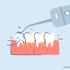 can a water flosser remove tartar