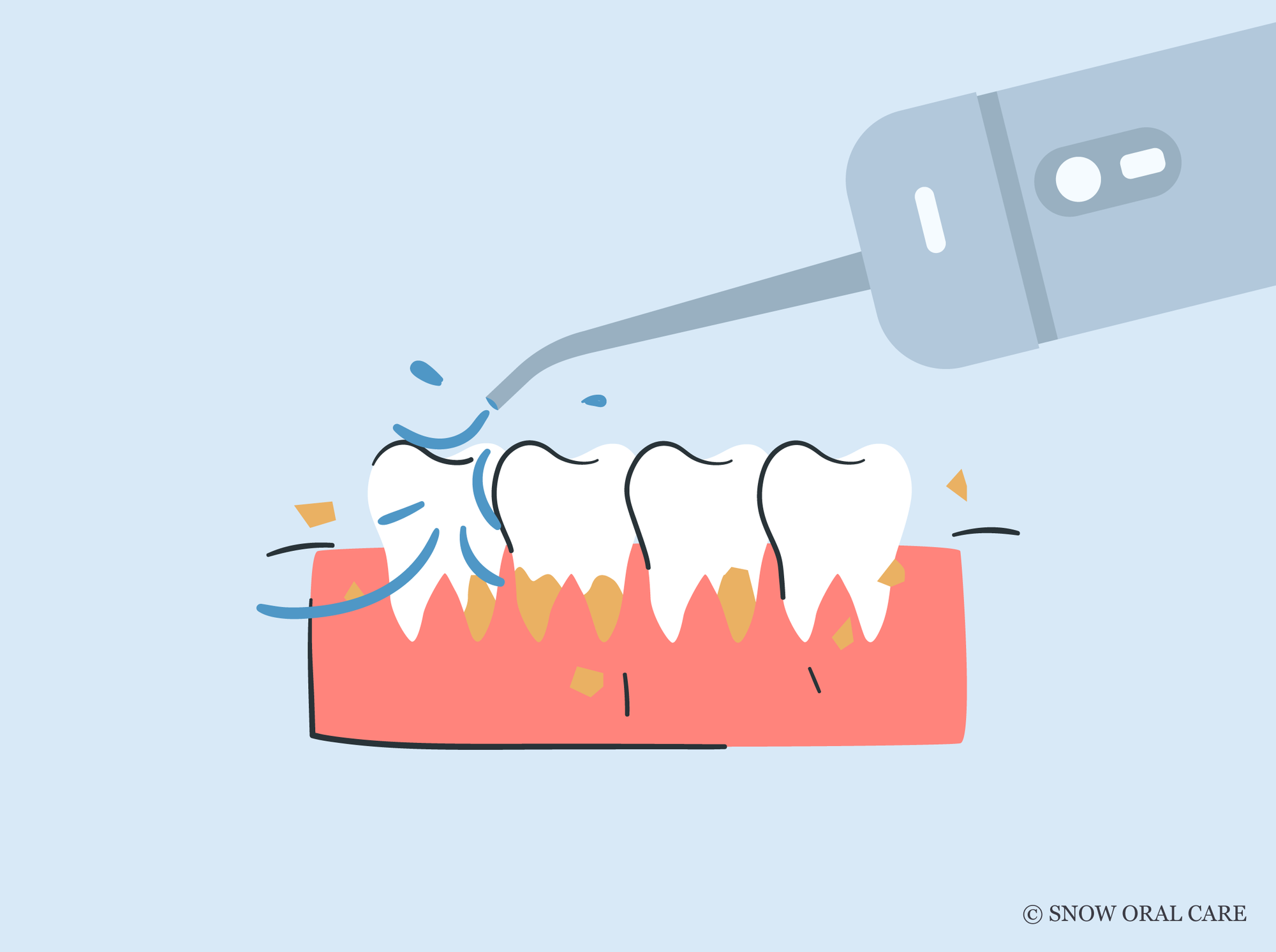 can a water flosser remove tartar