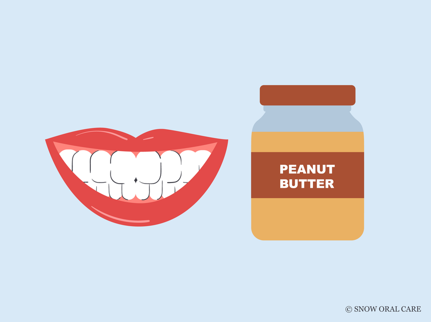 can i eat peanut butter after teeth whitening 