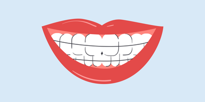 can i wear my retainer after teeth whitening