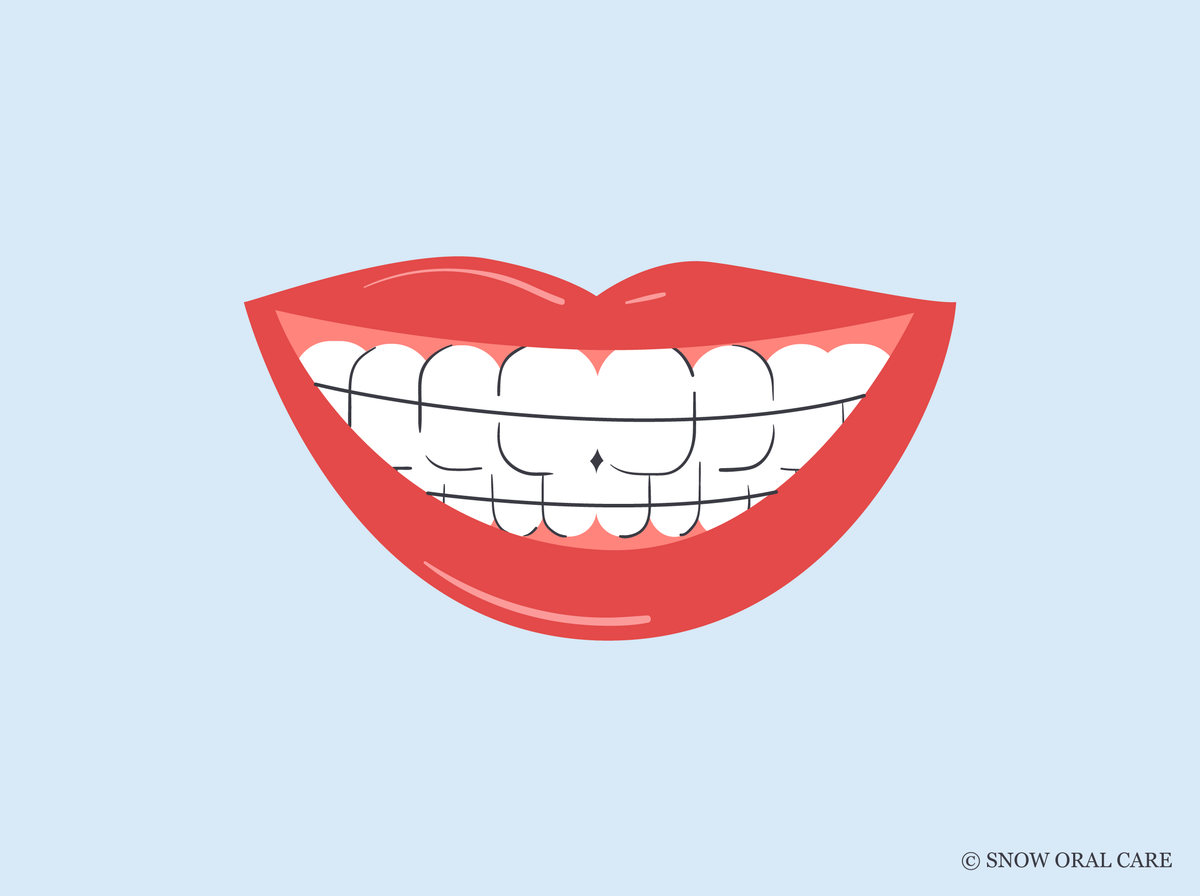 can i wear my retainer after teeth whitening