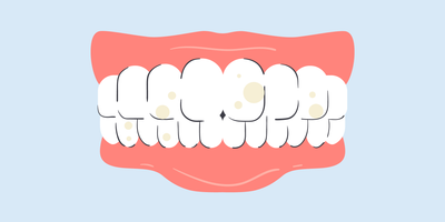 can too much whitening damage teeth 