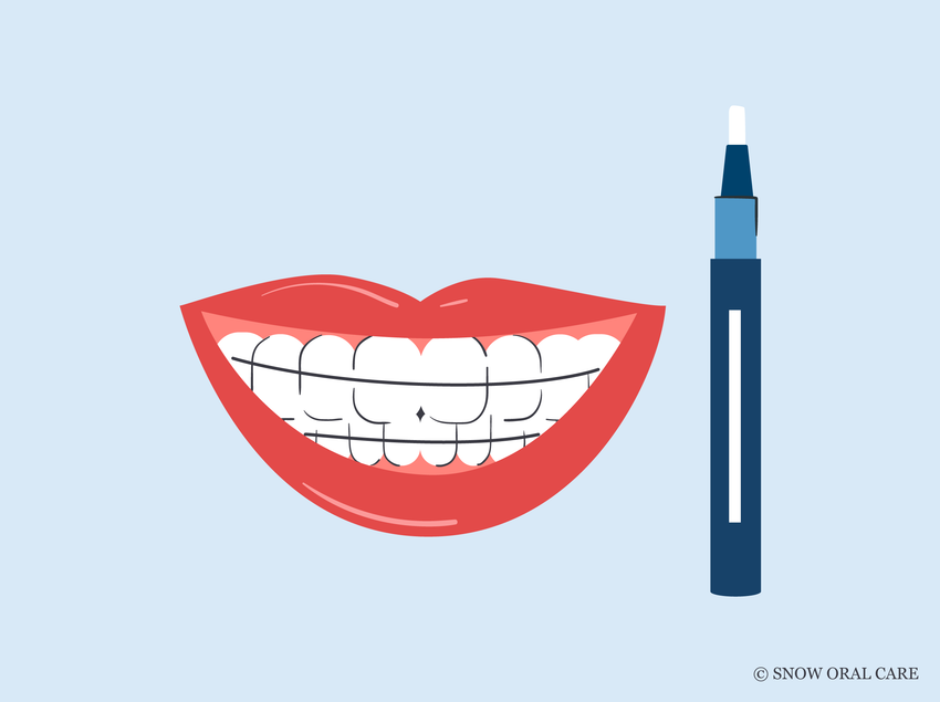 can you put teeth whitening gel in your retainer