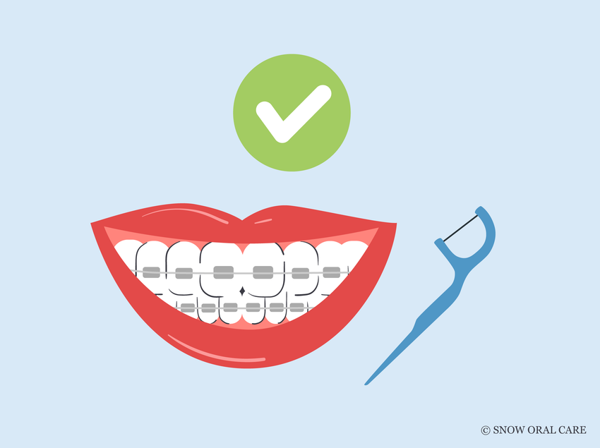 can you use floss picks with braces