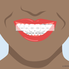 can you use teeth whitening strips with braces 