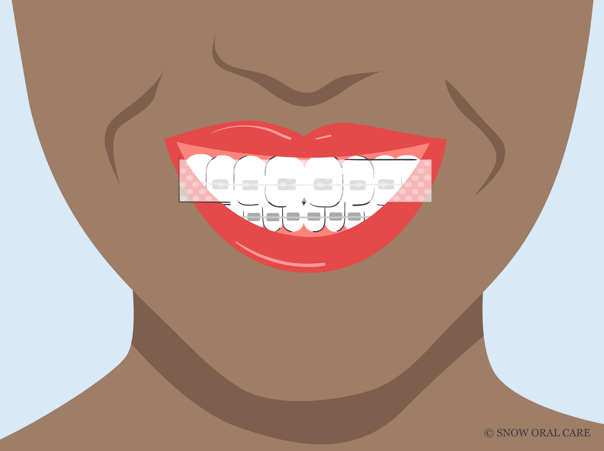 can you use teeth whitening strips with braces 
