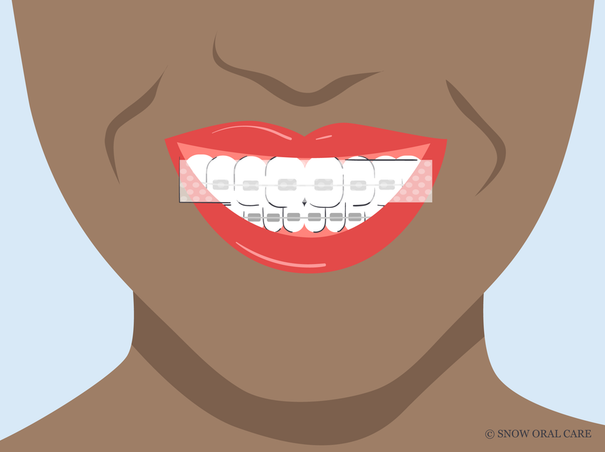 can you use teeth whitening strips with braces 