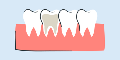 can you whiten a root canal tooth 