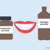 carbamide peroxide vs hydrogen peroxide teeth whitening