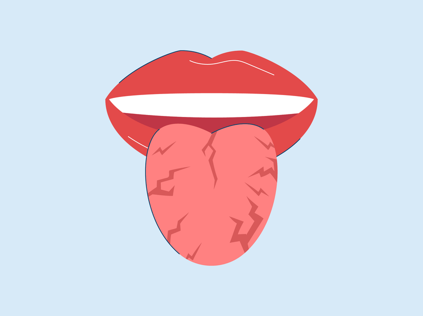 cracks in tongue