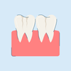 craze lines teeth causes and treatment