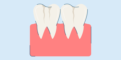 craze lines teeth causes and treatment