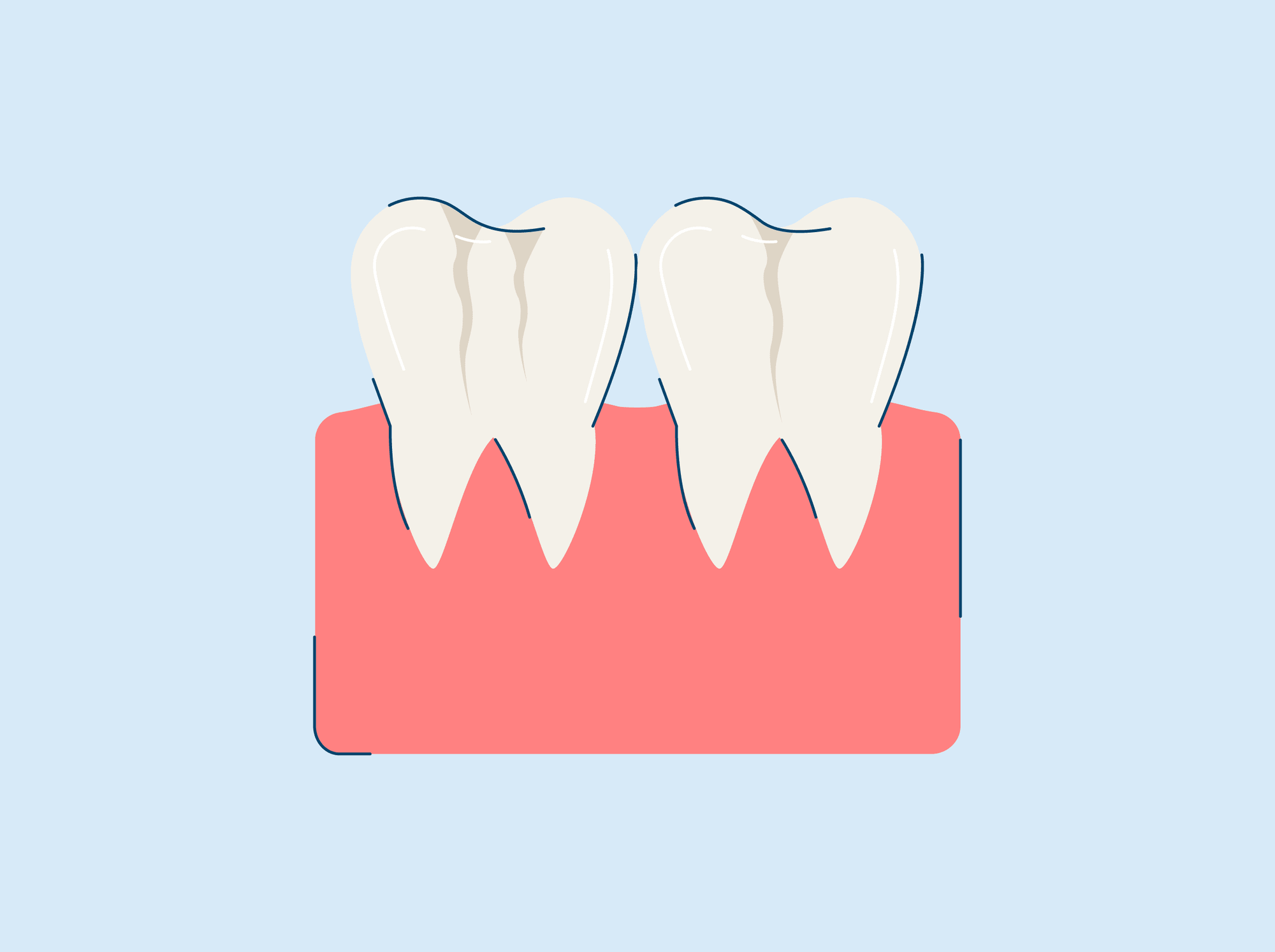 craze lines teeth causes and treatment