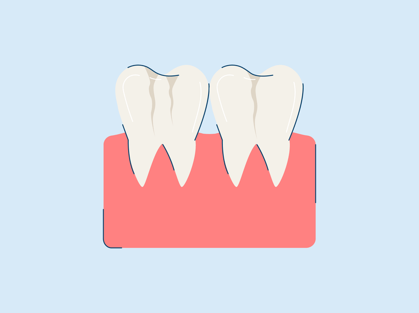 craze lines teeth causes and treatment