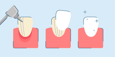 Dental Veneers Process: A Step-by-Step Guide