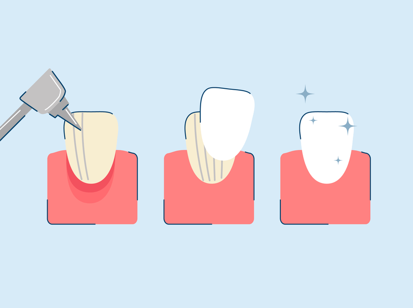 Dental Veneers Process: A Step-by-Step Guide