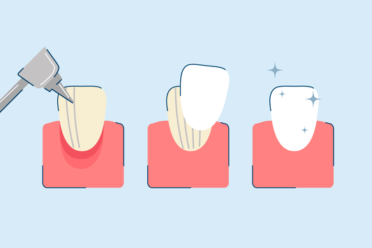 Dental Veneers Process: A Step-by-Step Guide