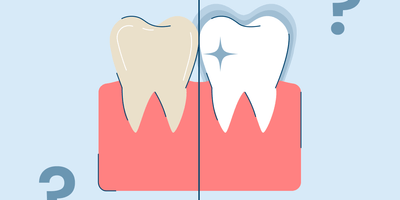 Does Fluoride Whiten Teeth? Here's Everything You Need to Know