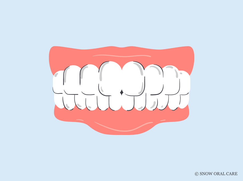 does teeth whitening damage enamel 